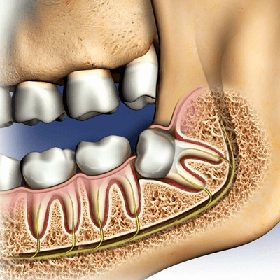 Expert Tips on Tooth Extraction in Dubai