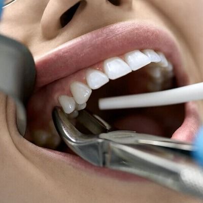 Understanding Tooth Extraction in Dubai Easily