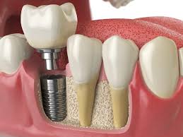 Factors That Affect Tooth Extraction Cost in Dubai