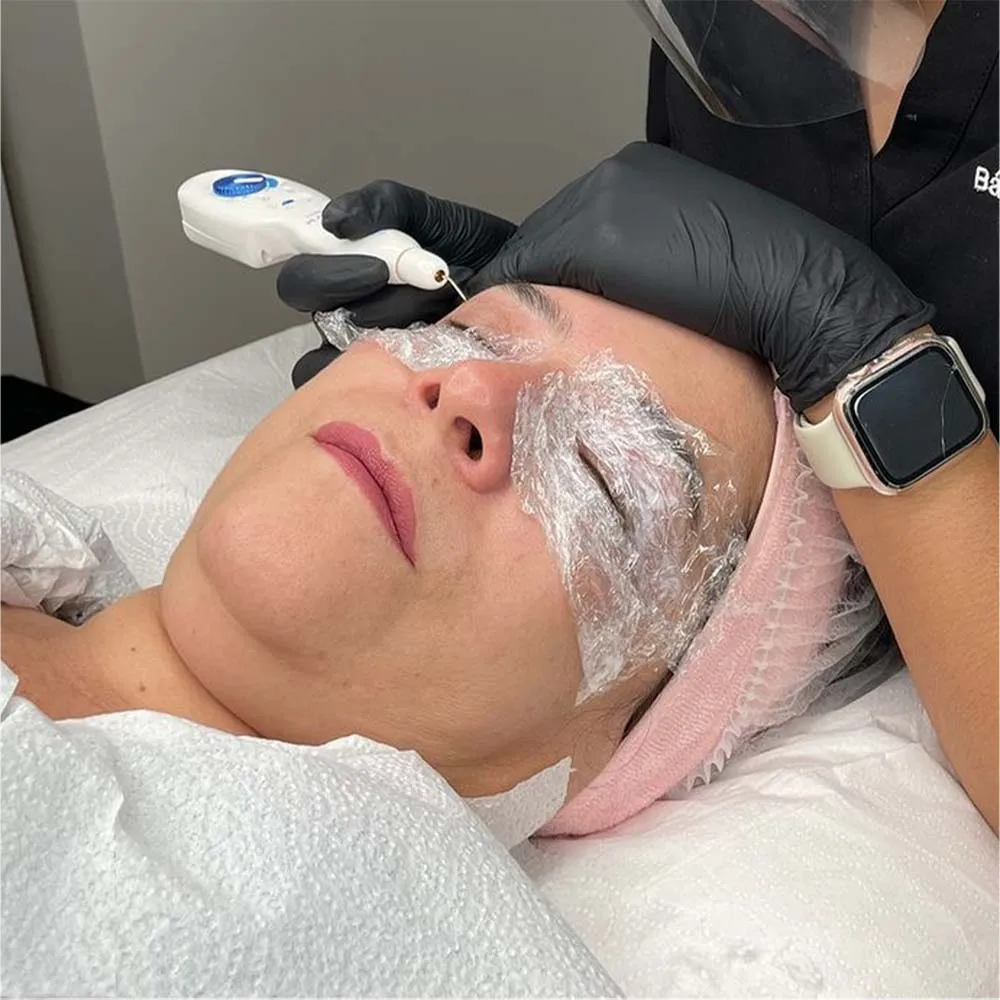 How Plasma Pen Treatment Works for Flawless Skin