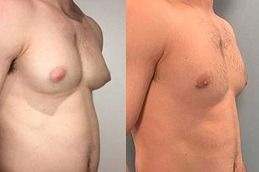Gynecomastia Cost Breakdown Simplified