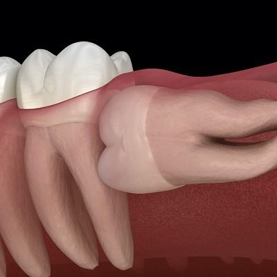 Top Factors Driving Tooth Extraction Pricing