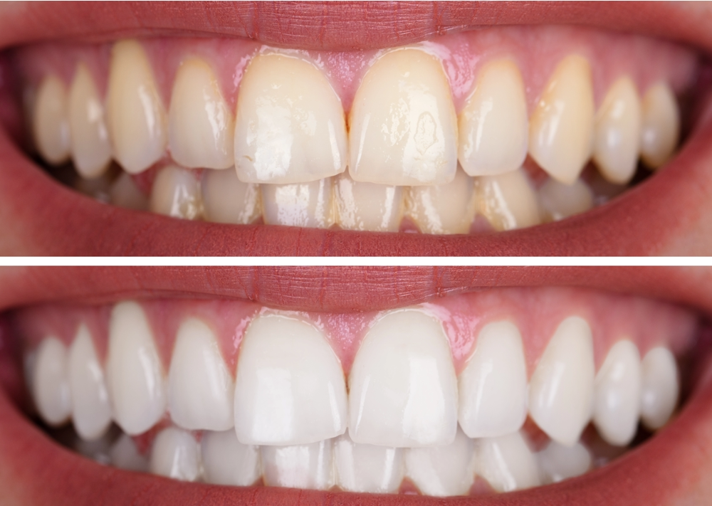 Glow Smarter With This Teeth Whitening Cost in Dubai Guide