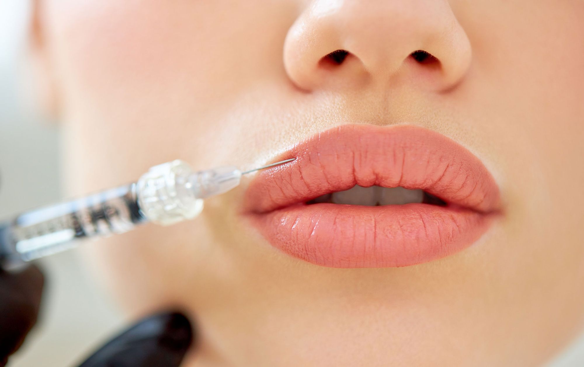 Russian Lip Fillers Turn Simple Lips Into Stunning Features