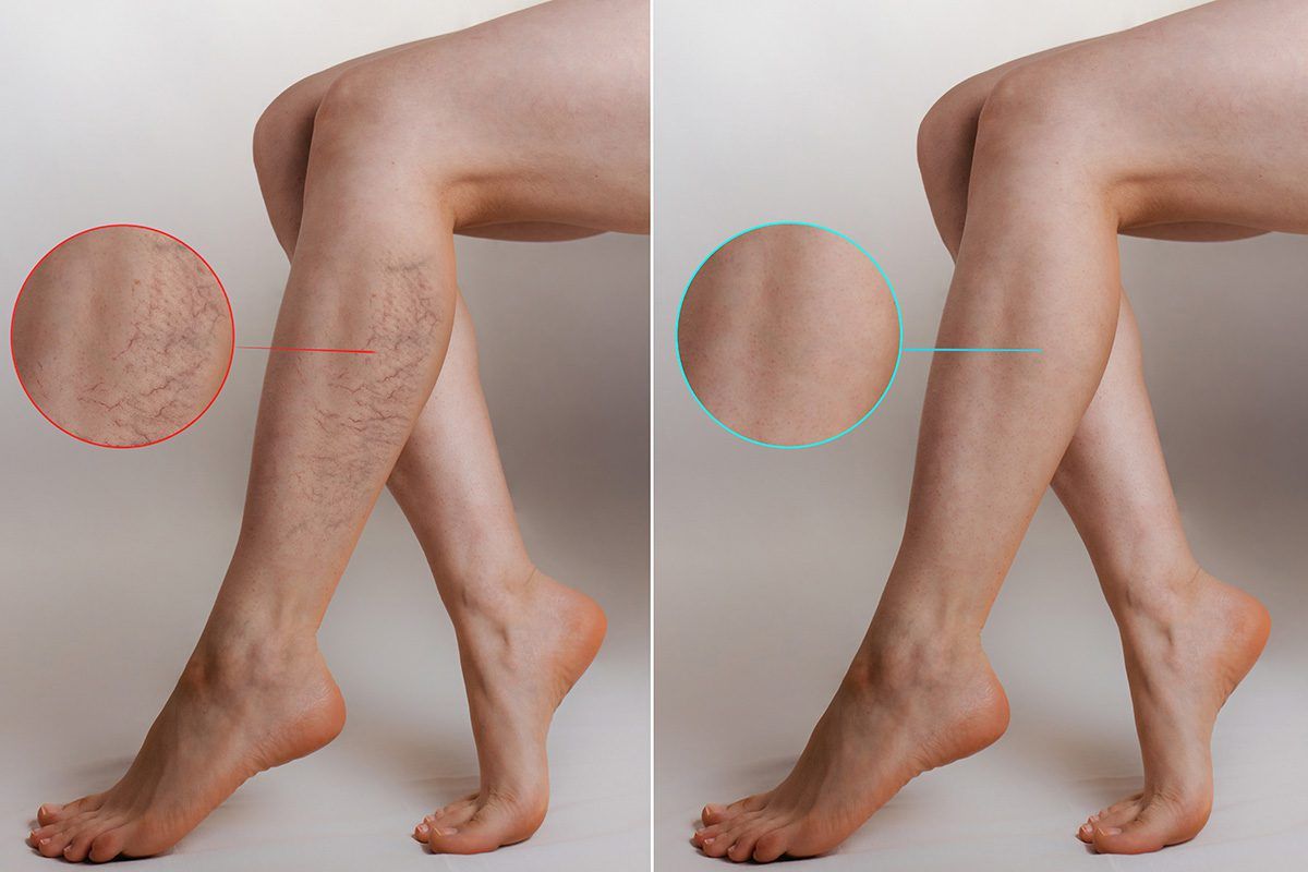 Spider Veins Treatment soft radiant sleek beauty spark