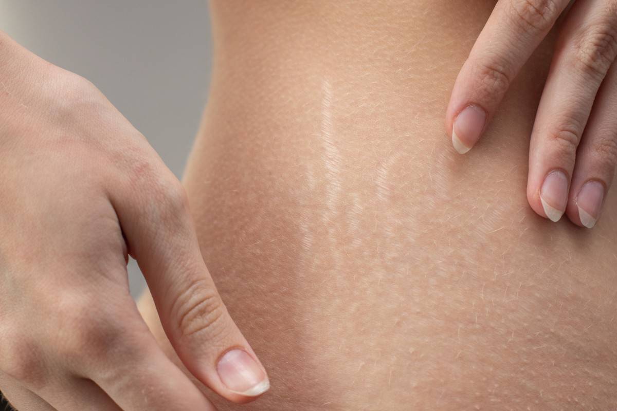 Laser Stretch Marks Treatment bringing silky skin feel and glow perfection